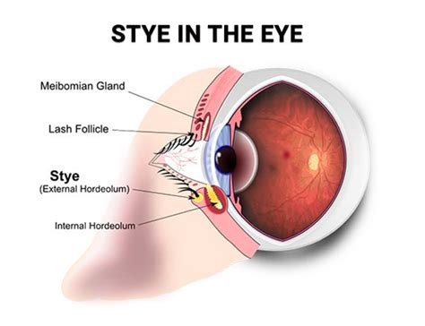 Lump In Eyelid Home Remes - Infoupdate.org