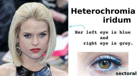 Heterochromia Iridum