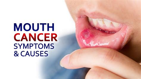 Mouth Cancer Symptoms Warning Signs