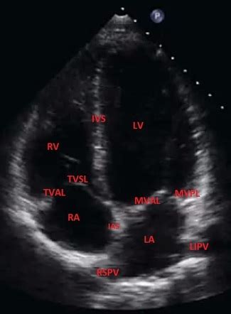 Echocardiography Anatomy