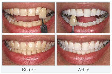 Teeth Whitening - DENTAL EXCELLENCE