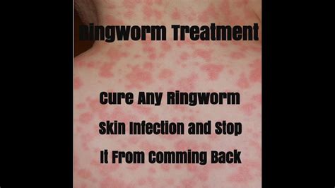 Human Ringworm Symptoms