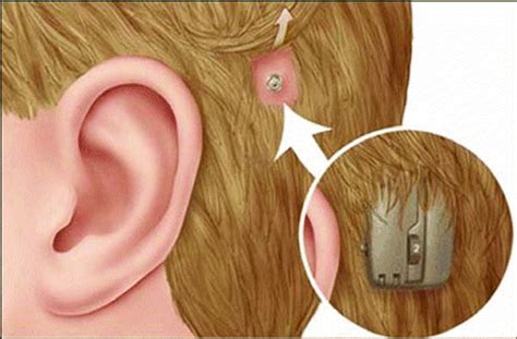 Types of Hearing Aid Devices