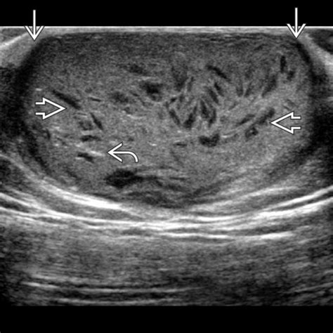 Epidermoid Cyst | Radiology Key