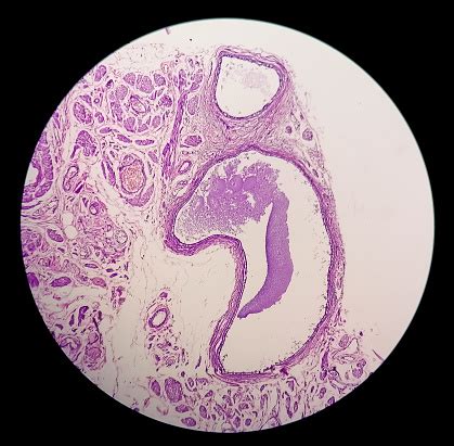 Histology Peritoneal Inclusion Cyst Paraovarian Cysts Hydrosalpinx And Lowgrade Cystic ...