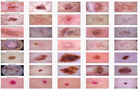 Stages of skin cancer | Download Scientific Diagram