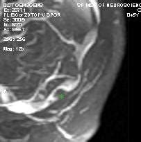 Dr Balaji Anvekar FRCR: Giant Arachnoid granulation