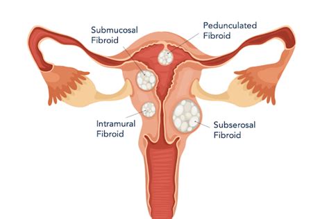 Fibroid Types, Sizes, Location, & FIGO Classifications Explained