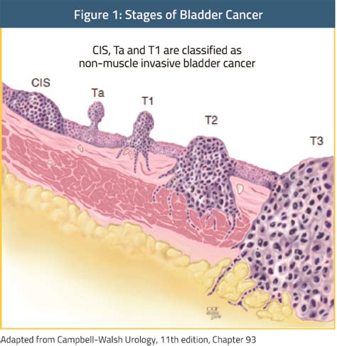 Stages Of Bladder Cancer In Men