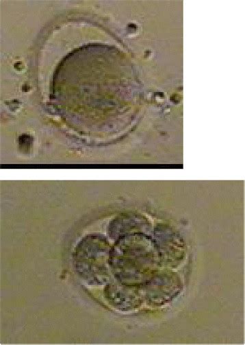 Enlarged Perivitelline space oocyte and corresponding day 3 embryo. | Download Scientific Diagram