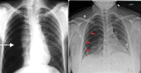 Chest X-ray showing large right pneumothorax with collapsed lung ...