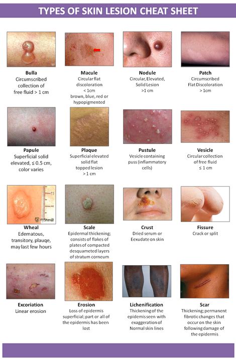 Types of Skin Lesion - StudyPK