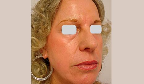 Fine Lines & Wrinkles Treatment | Aesthetipedia.com