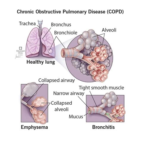 COPD - Human Diseases - Research Guides at Community College of ...