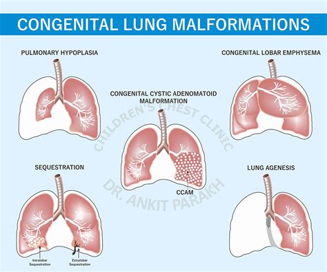 Congenital Lung Diseases - Dr. Ankit Parakh