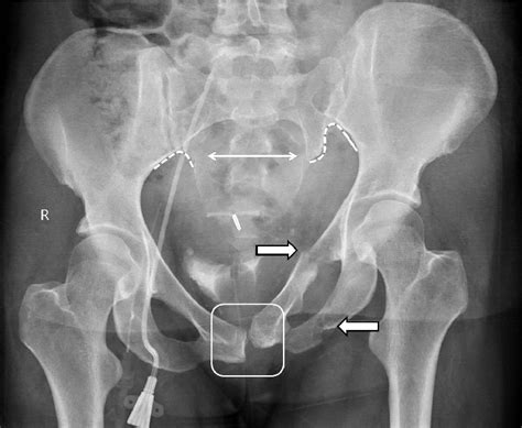 Ap Pelvis X Ray Labeled