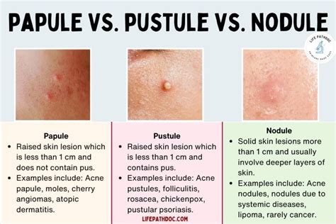 Papule vs Pustule vs Nodule: Pictures, Differences, and Causes