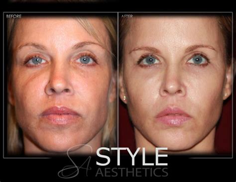 Liquid-Facelift-Face-Lift-Before-After-Photos-Portland-Oregon-0416 - Style Aesthetics by RajaniMD