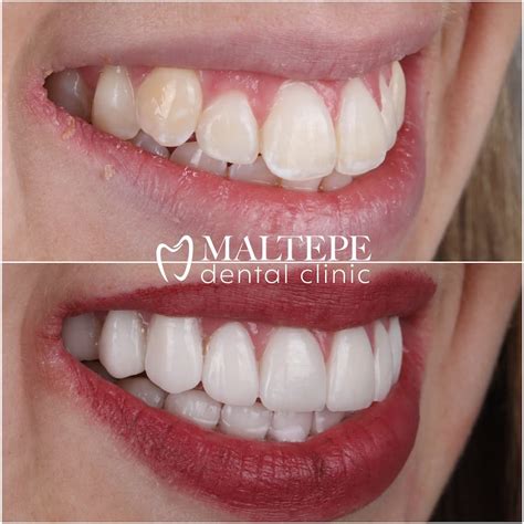 Buck teeth: Cause and Treatment - Maltepe Dental Clinic