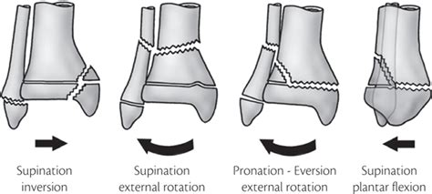 Different Types Of Ankle Fractures