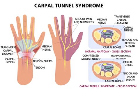 Carpal Tunnel Syndrome: Causes And Symptoms - Ask The Nurse Expert