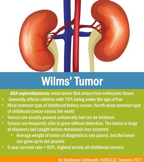 Wilms Tumor Nephroblastoma Symptoms, Prognosis, Treatment, 54% OFF