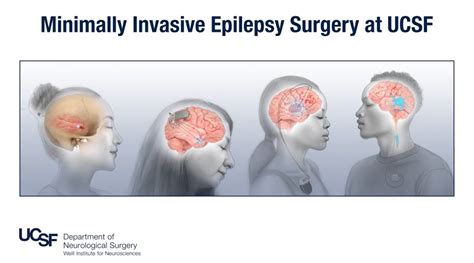 Brain Surgery Epilepsy