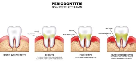 Recognizing The 4 Stages Of Gum Disease