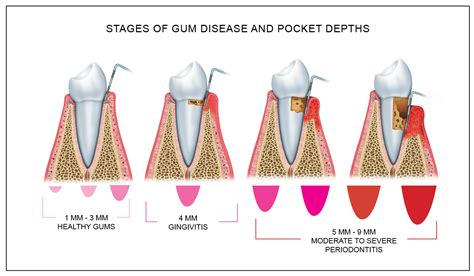 Printable Periodontal Probing Chart