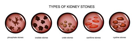 Types of Kidney Stones, Calcium, Uric Acid, Struvite and Cystine - Medfin