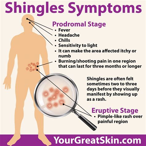 Tips for Treating and Preventing Shingles - Your Great Skin