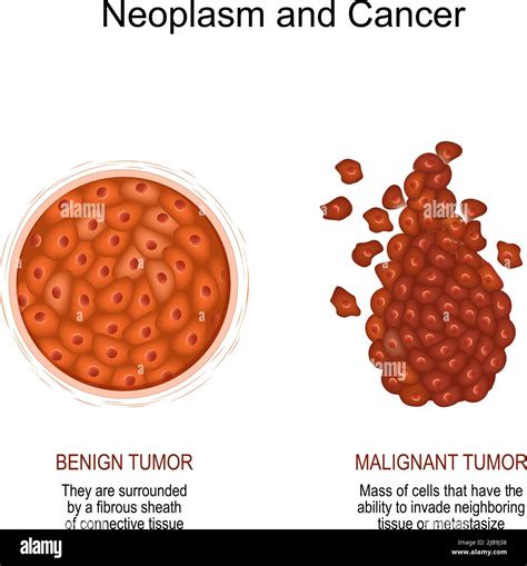 Neoplasm and Cancer. Comparison and difference of a malignant and benign tumor. benign tumor ...