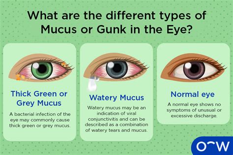 Types Of Eye Mucus, Discharge, And Boogers, 55% OFF