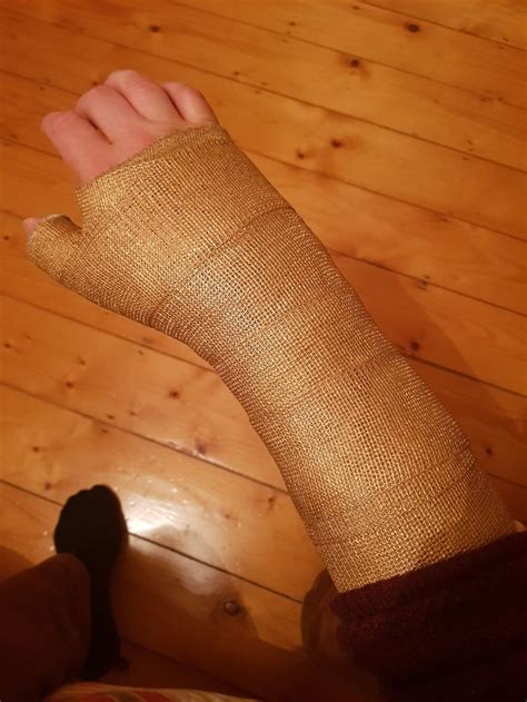 After Breaking My Wrist, I Turned My Plain Cast Into Thanos‘ Infinity Gauntlet | Bored Panda