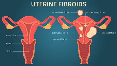 Uterine Fibroid Pain Symptom Relief | Everyday Health