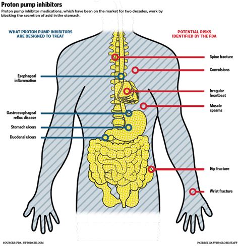 Proton pump inhibitors - Boston.com