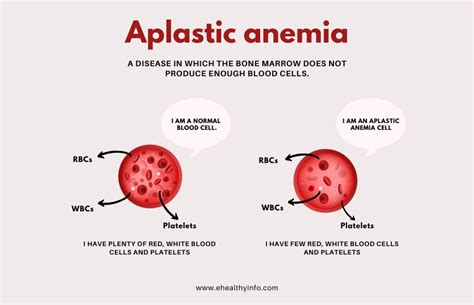 Aplastic Anemia - E-Healthy Info