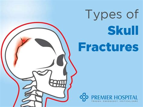 Types Of Skull Fractures