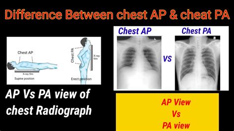 Difference between Chest AP & PA # Chest PA Vs AP # || By BL Kumawat # - YouTube