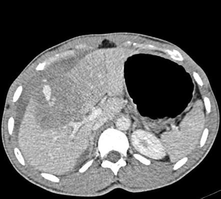 AAST liver injury scale | Radiology Reference Article | Radiopaedia.org