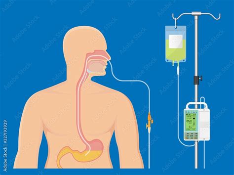 PEG gastric nasojejunal orogastric inserted nasoduodenal gastrojejunostomy jejunostomy nares ...