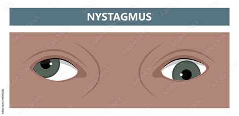 miosis eye pupil size iris retina brain Horner miotic muscle dilated ocular injury ptosis reflex ...