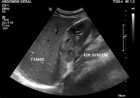 Pyelonephritis Ultrasound