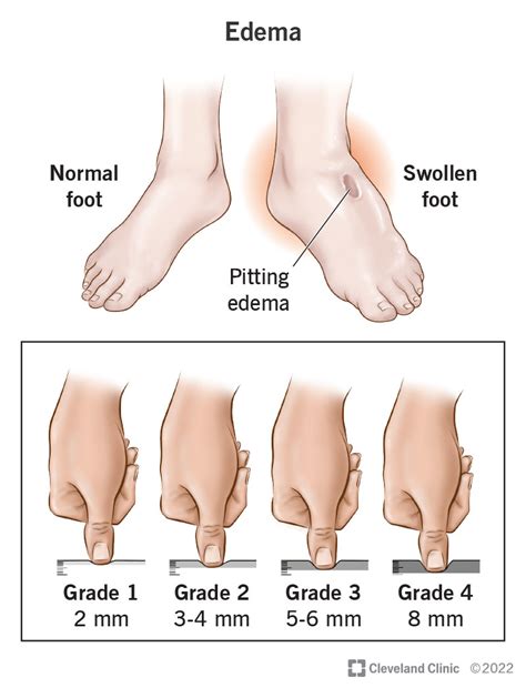 Pitting Edema: What Is It, Causes, Grading, Diagnosis,, 43% OFF