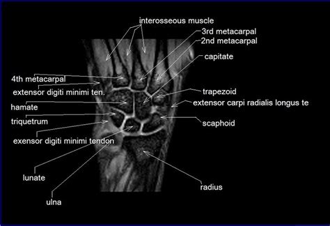 Wrist Ligament Anatomy Mri