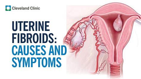 Fibroid Treatment