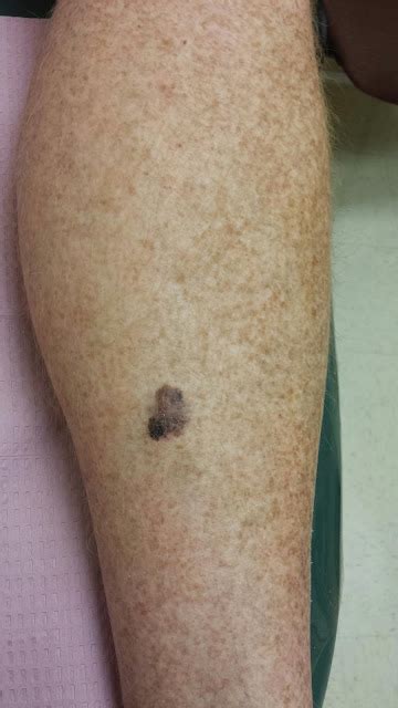 Dr. K. Lam Straight Talk: Malignant Melanoma on the Leg at www ...