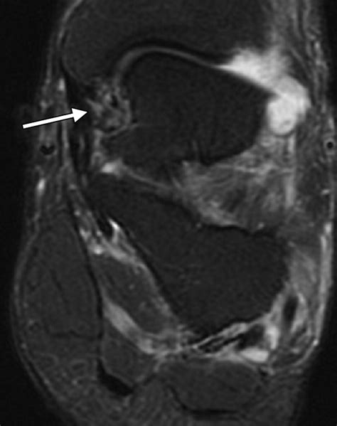 MR Imaging of Deltoid Ligament Pathologic Findings and Associated Impingement Syndromes ...