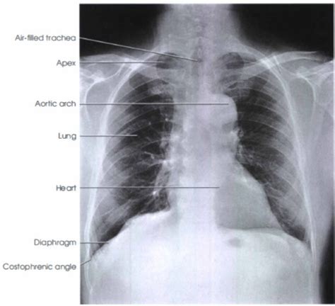 Chest : PA View | Radiology Basics | Radtechonduty