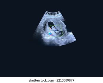 Little Baby Ultrasound 8 Weeks Gestation Stock Photo 2213589879 ...